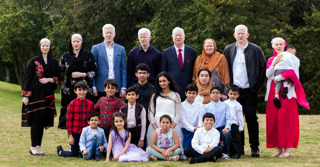 Familjen Parvez har utsetts till världens största albino-familj av Guiness rekordbok. Totalt har de 15 släktingar med albanism världen över. Familjen Parvez