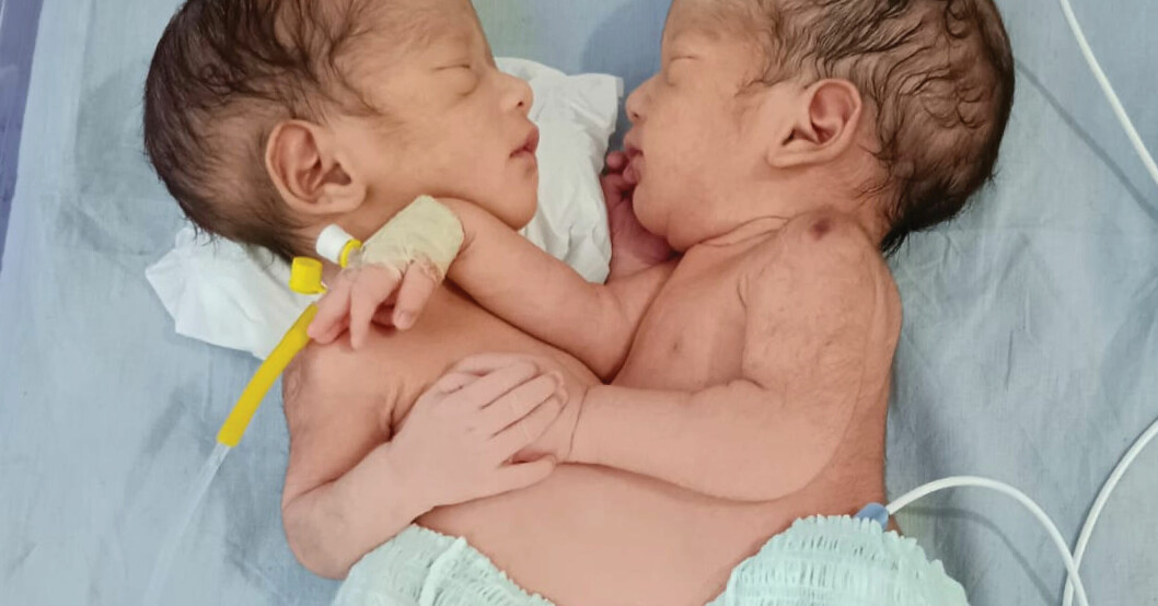 Efter otroliga förlossningen av siamesiska tvillingar – mammans läkare: ”Sällsynta barn”