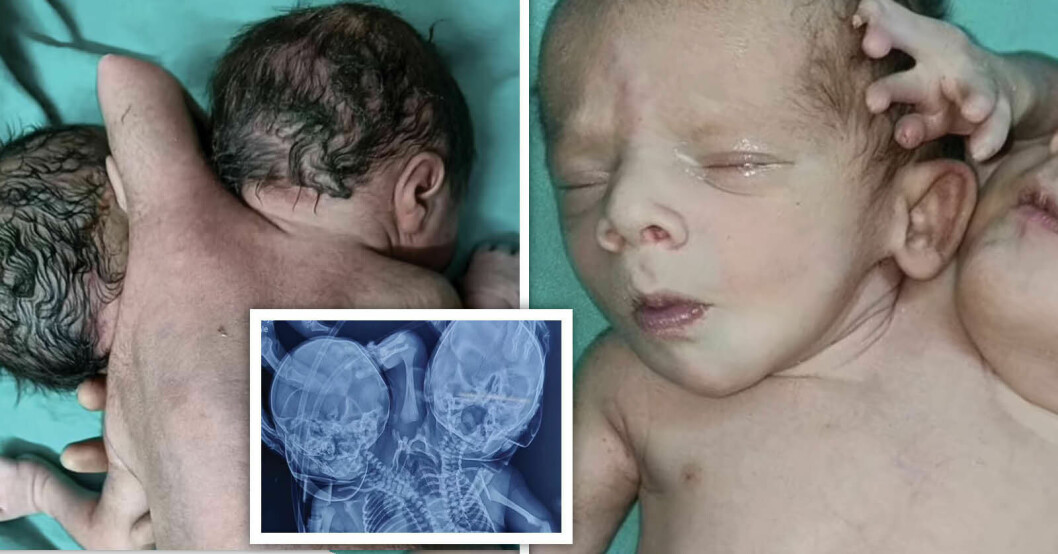 Unika mirakelbarnet – föddes med två huvuden, tre armar och två hjärtan