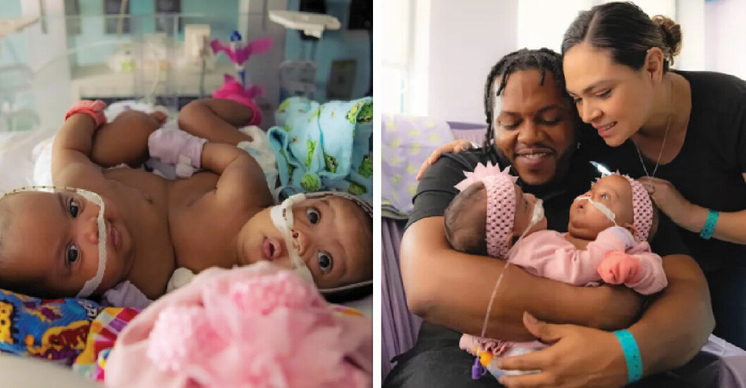 16-veckor gamla siamesiska tvillingarnas lycka – efter svåra operationen