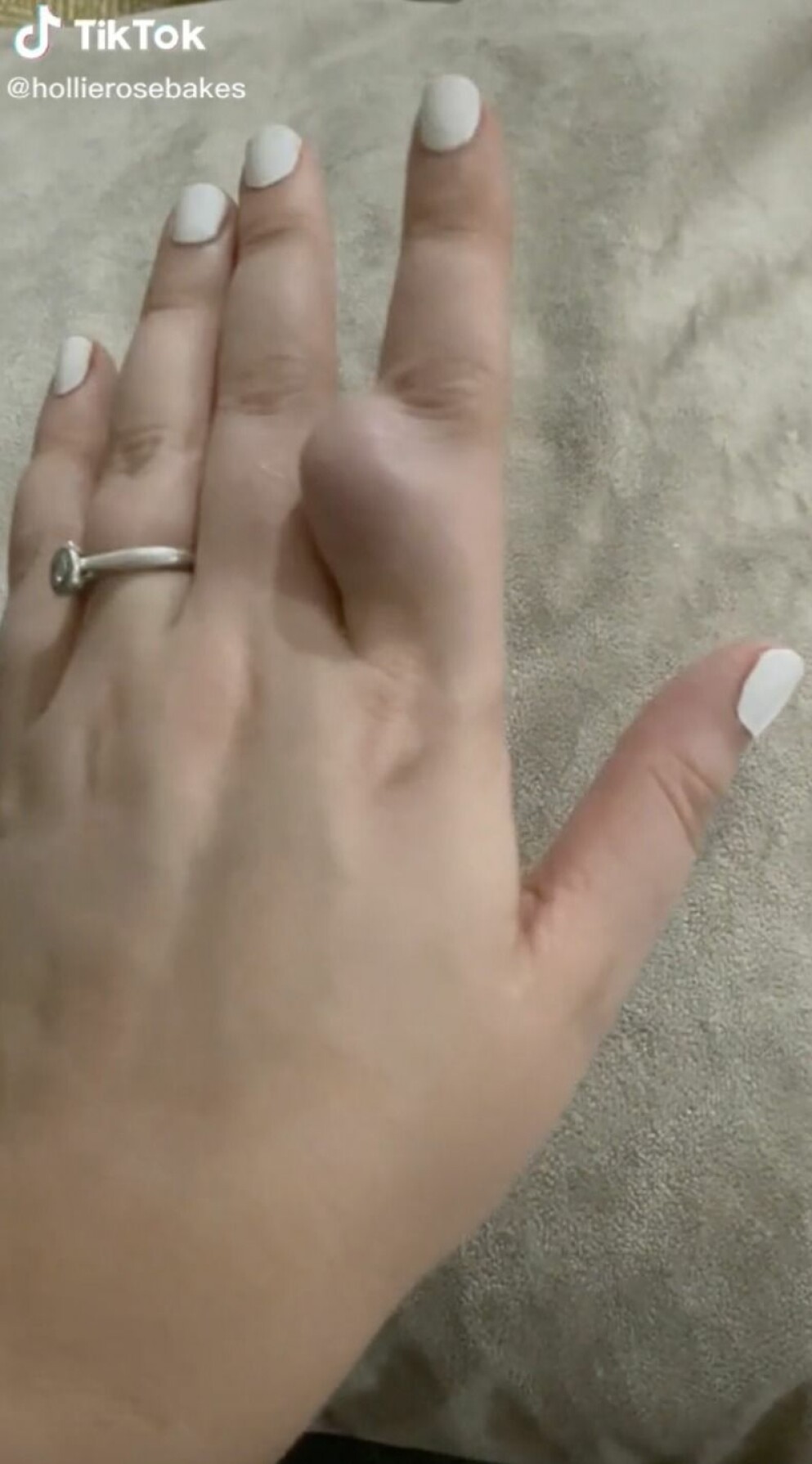 För drygt ett år sedan upptäckte Hollie en knöl på sitt pekfinger. Läkarna avfärdade det som en cysta, men när den växte blev Hollie orolig och gjorde flera återbesök för att reda ut vad det handlade om. Hollies ”gravidfinger”