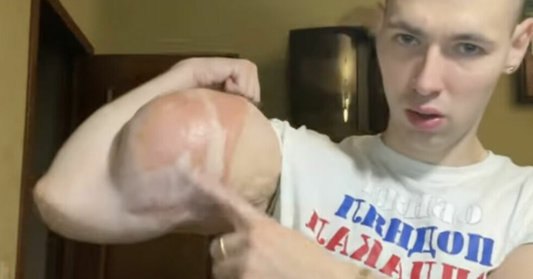Kirill Tereshin ville ha superhjältearmar och injicerade tre liter vaselin i armarna. Nu kan det bli hans död. Kirill Tereshin