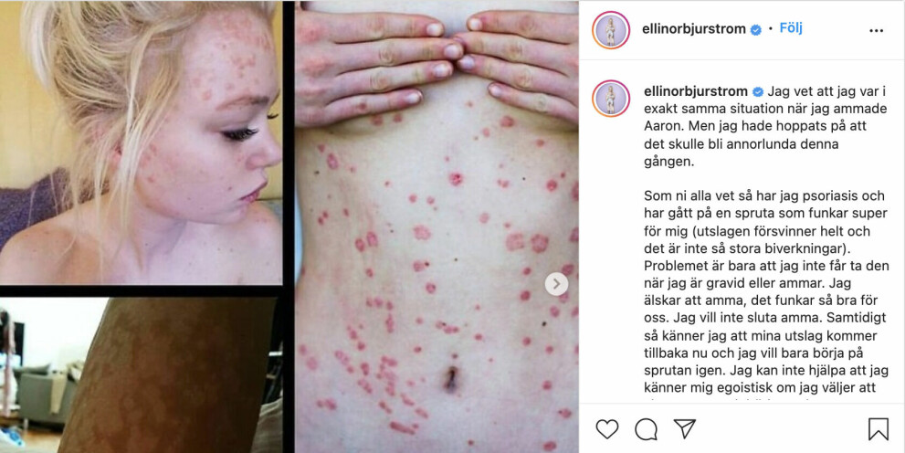<span class=" italic" data-lab-italic_desktop="italic">Ellinor Bjurström delar med sig av sin kroniska sjukdom på sin Instagram. Foto: Ellinor Bjurström</span>