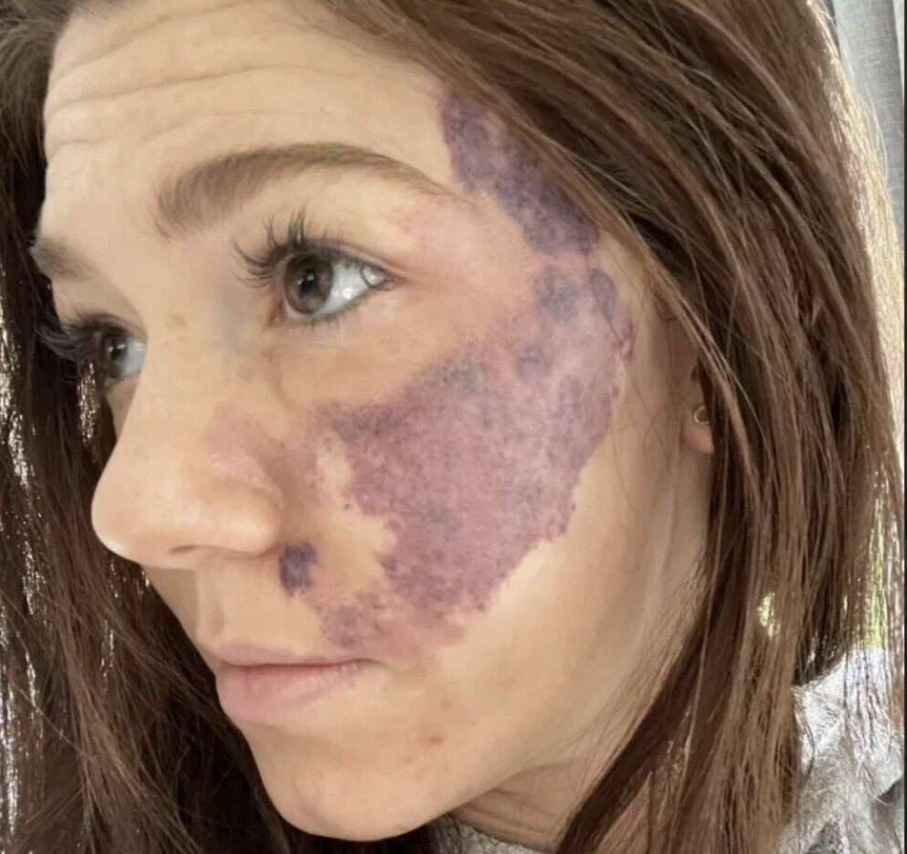 Emily Hallett vägrar visa upp födelsemärket för fästmannen Adam. Trots att de varit tillsammans i fem år har han aldrig fått se det, enligt Emily. Emily Hallett
