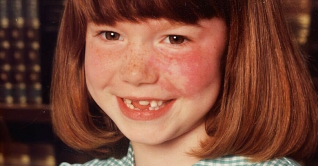 Emily Hallett har haft ett gigantiskt födelsemärke sedan födseln. Som barn mobbades hon svårt och sedan dess har hon haft dåligt självförtroende. Emily Hallett