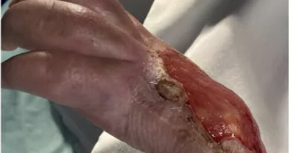 Jade Harles hand har inte varit sig lik sedan hon räddade en person från att drunkna. Jade Harle