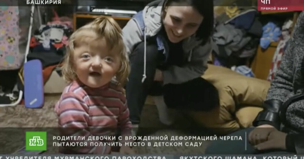 Sofya Zakharova, 2, får inte börja förskolan på grund av sitt utseende. Sofya Zakharova