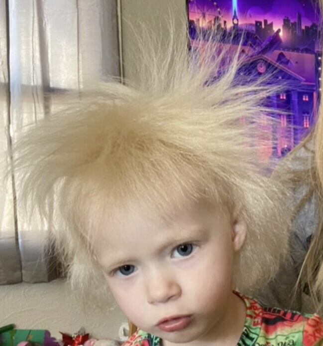 Hon har fått diagnosen Uncombable hair syndrome.
