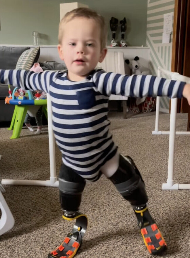 Nu har Louie gått på sina proteser i ungefär tre månader och han har blivit en riktig fena på att använda dem. Nu har Louie gått på sina proteser i ungefär tre månader och han har blivit en riktig fena på att använda dem.
