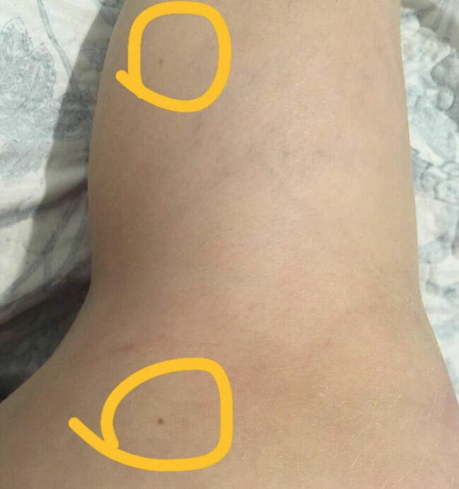 I de inringade fälten finns fräknarna som Julia menar är likadana som de som Madeleine hade. I de inringade fälten finns fräknarna som Julia menar är likadana som de som Madeleine hade.