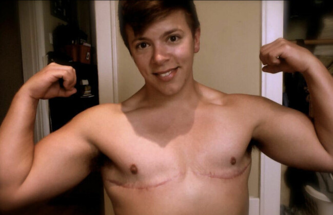 Fyra månader efter att Danny opererat bort sina bröst såg han ut så här. Då hade han även tagit testosteron i ett år.