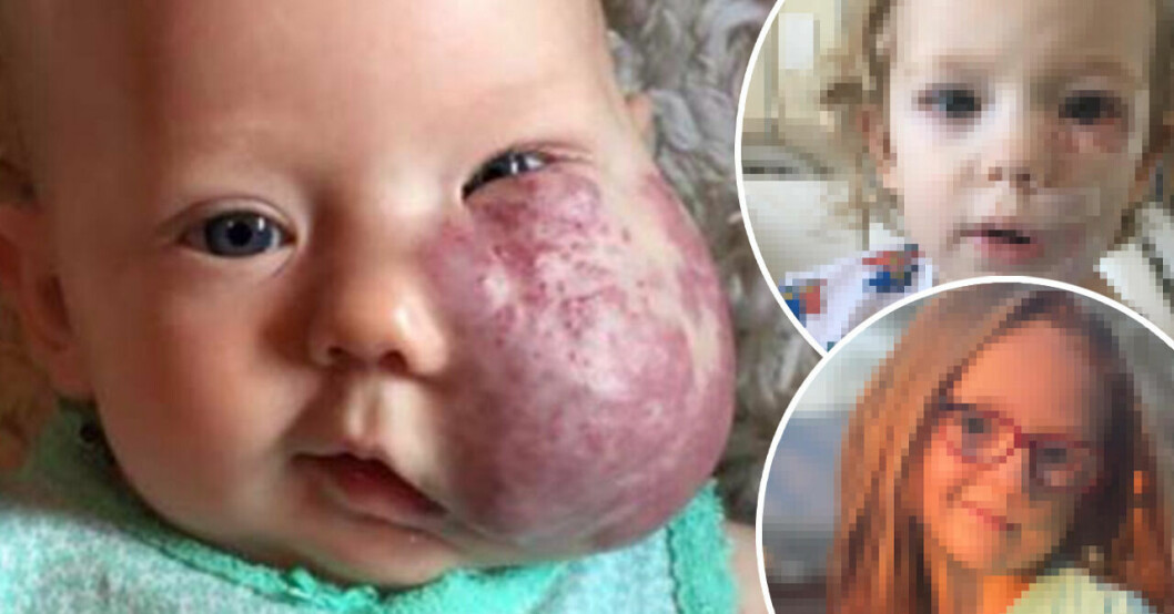 Bebisen föddes med gigantisk ansiktstumör – så ser Sloan, 8, ut i dag.