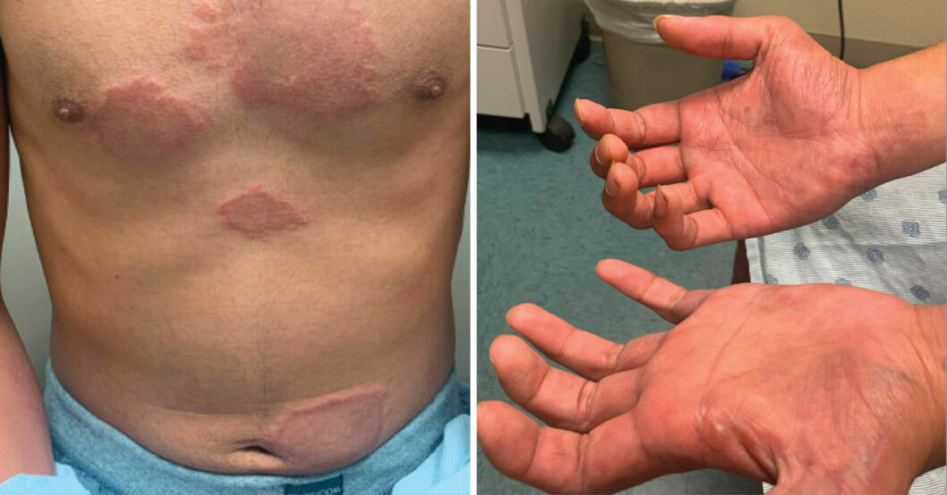 En 20-åring från Texas, USA, diagnostiserades med en sjukdom från medeltiden.