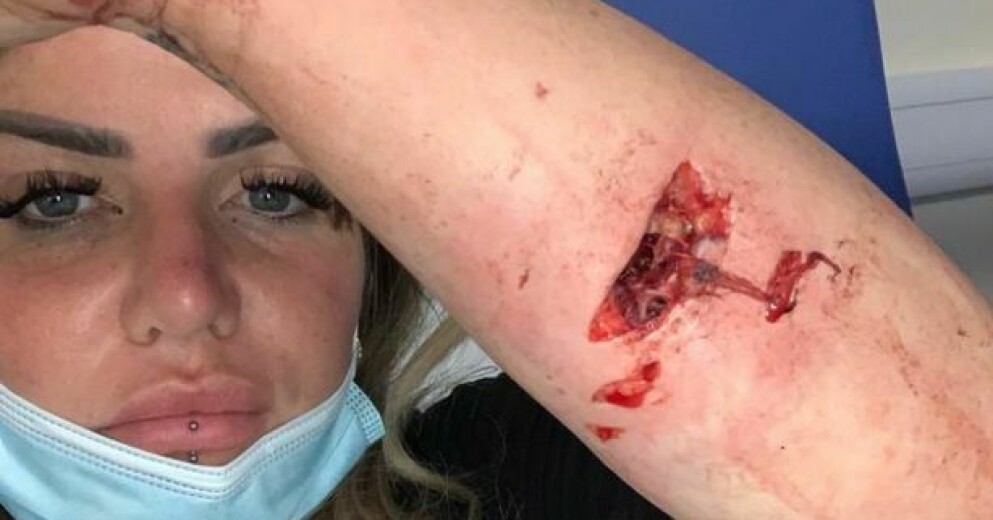 Stephanie Jones blev biten 25 gånger av hunden Chase och fick föras till sjukhus. Stephanie Jones