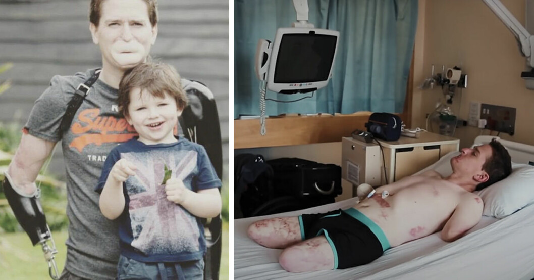 Alex Lewis bakom sin 11-årige son Sam och Alex i en sjukhussäng med amputerade armar och ben.