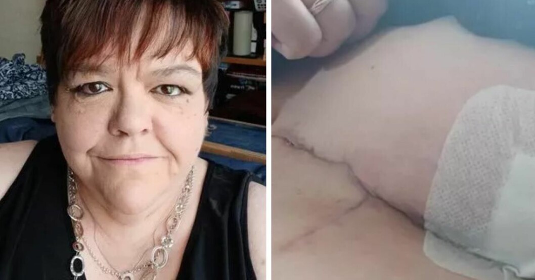 Sylvia fick skavsår av bh:n – slutade med att hon kämpade för sitt liv