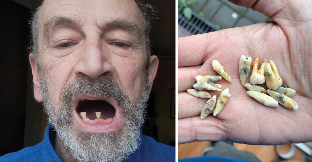 Pensionären George, 67, tvingades dra ut 11 tänder med tång: ”Inte råd”