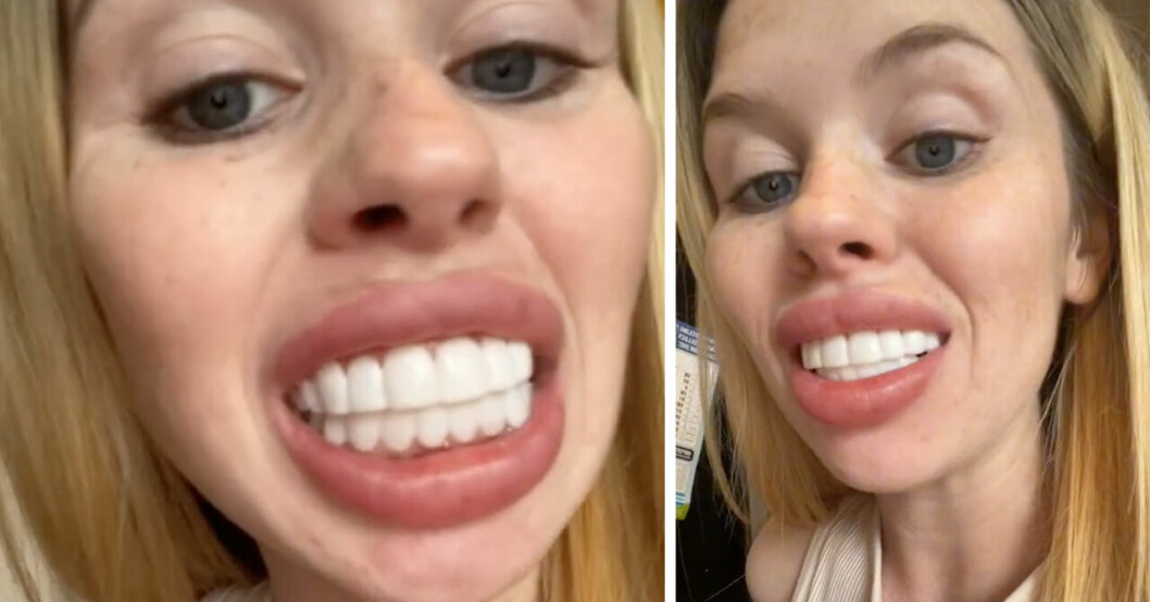 Lauren Hartley visar upp sin tandprotes.