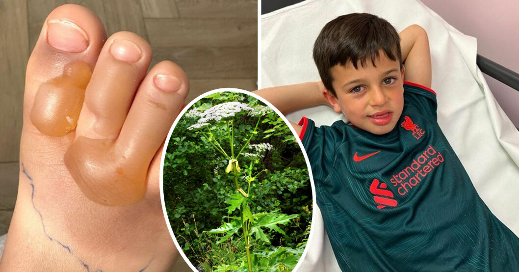 6-åriga Jaxon fick blåsor på fötterna och orsaken var en vanlig växt.