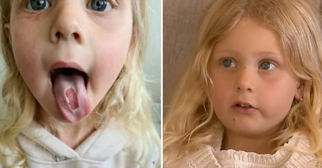 <strong>Willow, 4, visar skadan hon fick av godiset.</strong> Willow, 4, visar skadan hon fick av godiset.